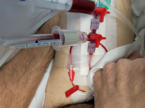 cateter radial  practice  tips imprescindibles  su