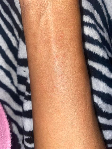 What Causes A Rash On Both Arms at Benjamin Hutchison blog