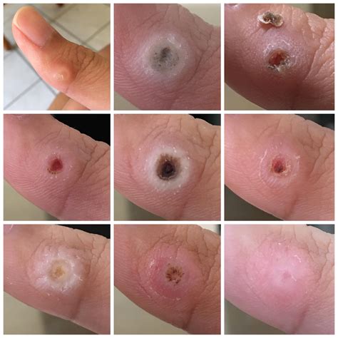 Plantar Wart Vinegar at Frank Ray blog