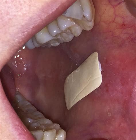 Treat Tongue Ulcers