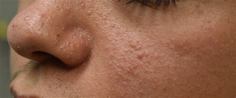 Tuberous Sclerosis | School of Medicine