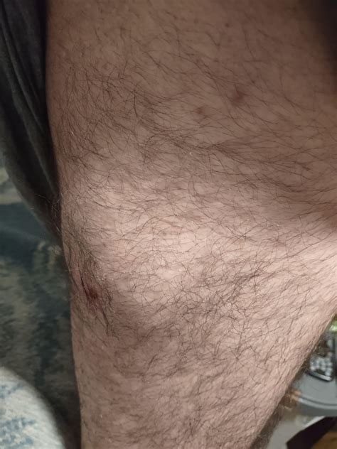 Desert Recluse bite update : r/spiderbites