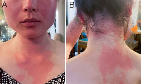 scombroid poisoning  travellers tale  medical journal  australia