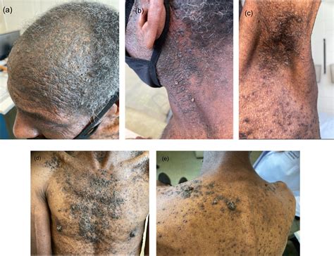 A case study on the dermatoscopic findings of Darier's disease in skin