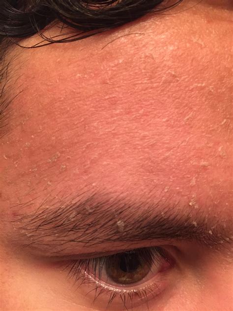 How Do You Get Dead Skin Off Your Face at Viola Lynch blog