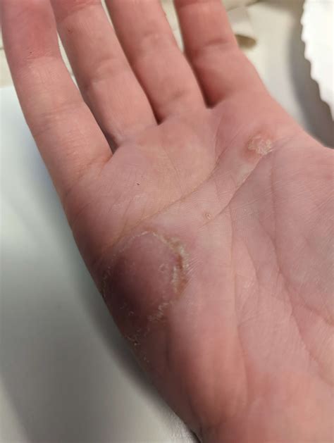 dermatologist   thought  ringworm    respond