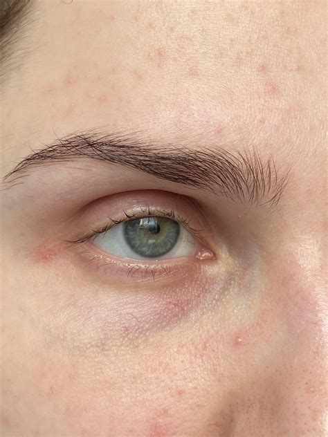 [Acne] Tiny white bumps on face, any recommendations? : r/SkincareAddiction