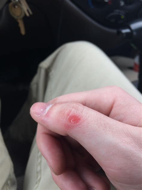 Thumb keeps blistering? : r/Bowling