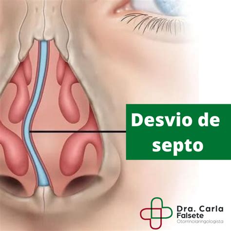 O Que Causa Desvio De Septo - Entenda o que é desvio de septo e quais os sintomas - Dra. Carla Falsete