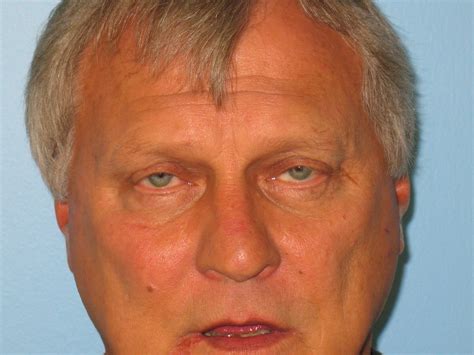 Blepharoplasty Before & After Photos | Myers Plastic Surgery