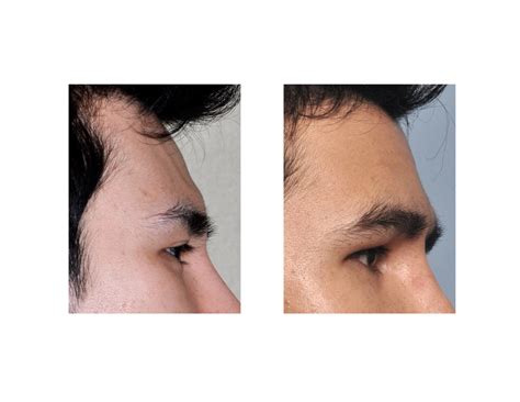 Case Study: Custom Male Forehead Implant - Explore Plastic Surgery