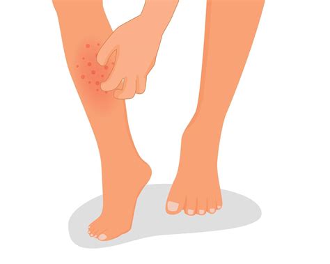 Man hand scratching his itchy leg with rash dry skin because of