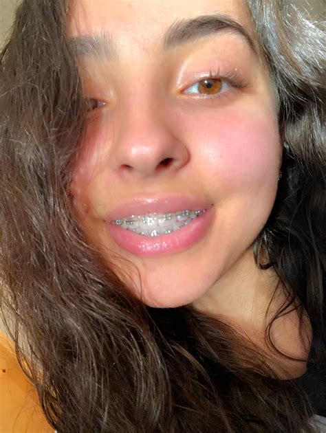 Braces Girl Video Viral at Thomas Reiser blog