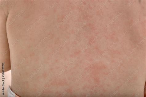 roseola rash  eczema  lisa bazan blog