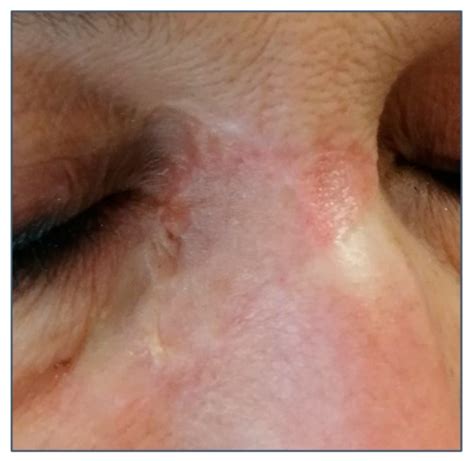 Basal Cell Carcinoma Nose