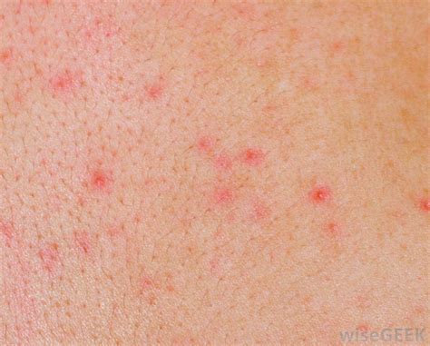 skin rashes gut brain healing  professor sundardas