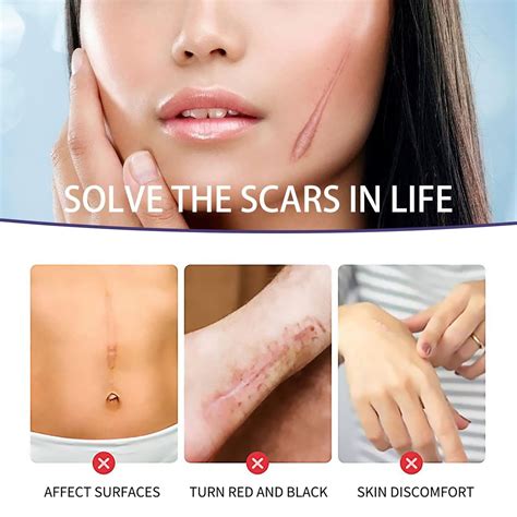 Buy Scar Away Silicone Scar Sheets (1.6” x 59”) Professional Reusable