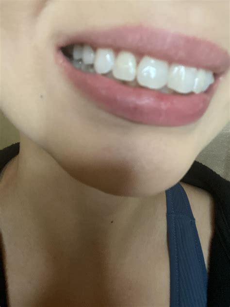 Staining between teeth : r/Invisalign