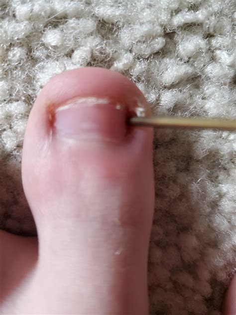 Infected Toe