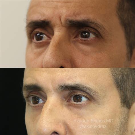 Non-Surgical Eye Bag Removal - La Jolla Dermatology