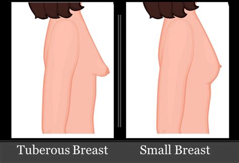 Why Breast Augmentation was One of the Best Decisions of Jane’s life