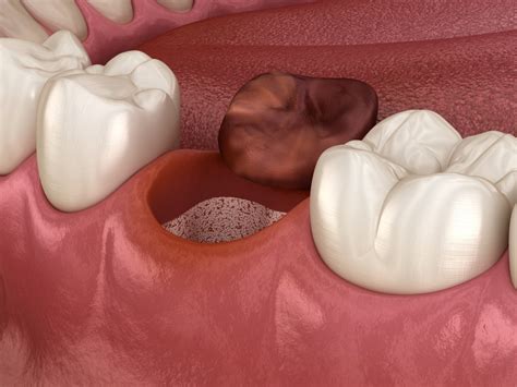 Dry Socket vs. Normal Healing: Key Differences