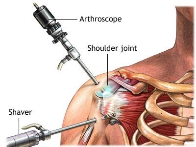 ROTATOR CUFF REPAIR - Eramosa Physiotherapy