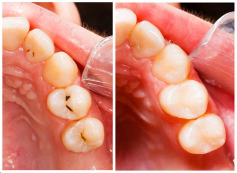 Composite Resin Fillings - Pickett Family Dental