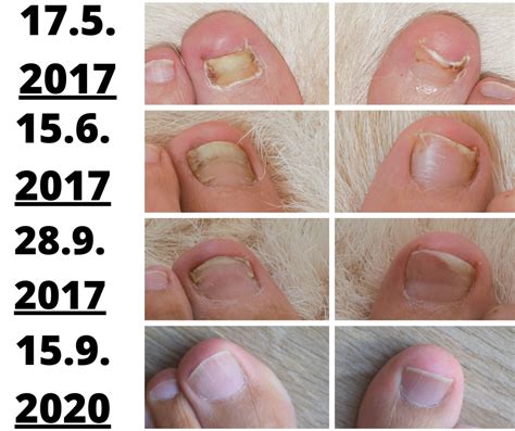 Candida albicans a iné mikroskopické huby spôsobujúce kvasinkové ...