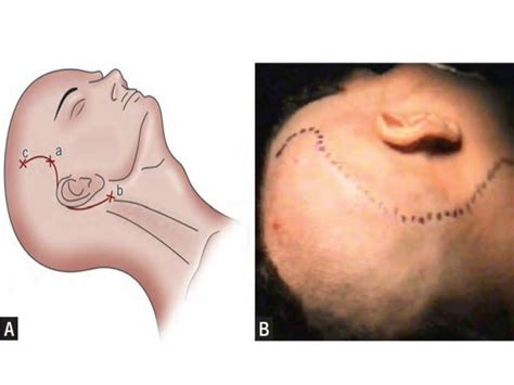 Jugular foramen anatomy and approaches