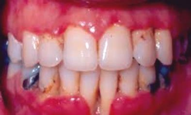 Trench Mouth - Treatment, Pictures, Symptoms, Causes, Treatment