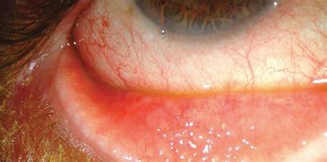 Lesson: Conjunctivitis: Know Your Differentials
