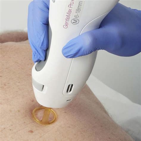 Laser Treatment for Benign Pigmented Lesions - SF Preventive Care