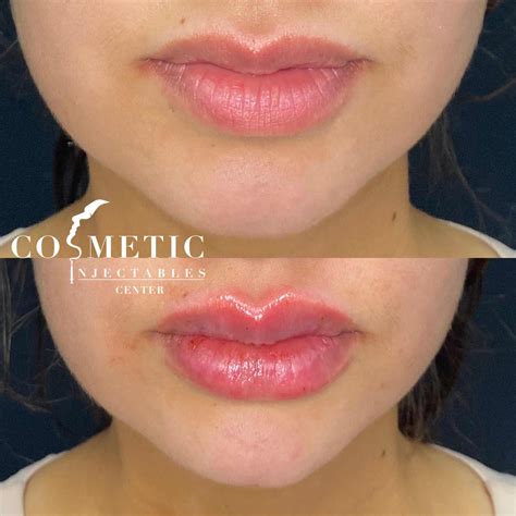 Lip Filler: Cost, Benefits, Side Effects, Reviews | Sherman Oaks