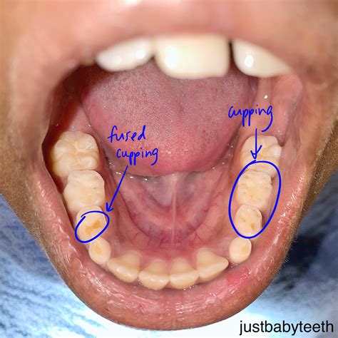 Dental erosion — justbabyteeth
