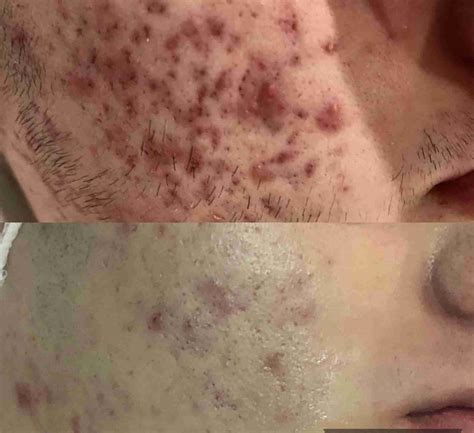 Shocking Truth About Unbelievable Blackhead Removal 2024 Revealed! Image 17