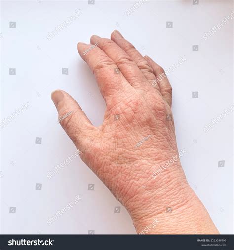 Skin Disease Dry Skin Cracks On Stock Photo 2263388595 | Shutterstock