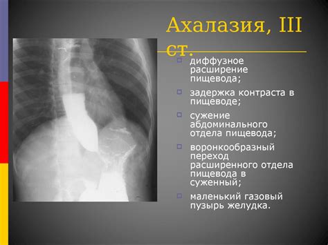 Заболевания пищевода. Ахалазия кардии. Эзофагопатия при системной ...