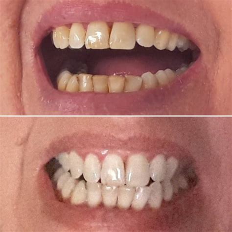The Best At-Home Teeth Whitening Kit [Dentist-Approved]