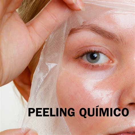 Peeling Químico | OZ CLINIC (Ex EO Clínica) - Medicina Estética y ...