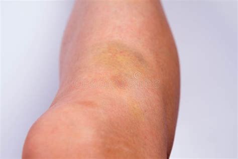 Bruised leg stock image. Image of fight, punch, womans - 101637639