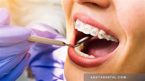What Are The Complications Of Wisdom Tooth/third Molar Surgery