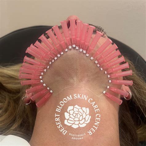 neck thread lift  scottsdale az pdo thread lift  neck