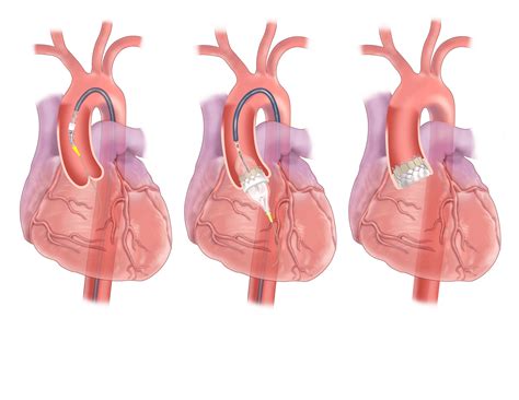 Heart Valve Replacement Surgery Need Types Procedure Types Of Heart