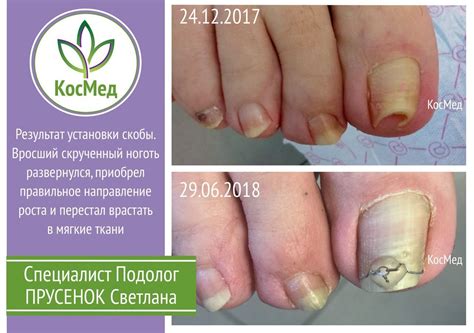 Лечение вросшего ногтя. Установка скоб. Купчино