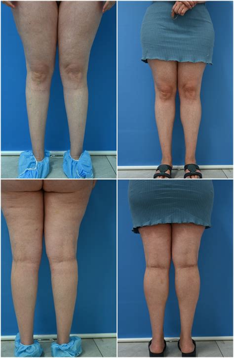Calf Implants - Dr. G Cosmetic Surgery