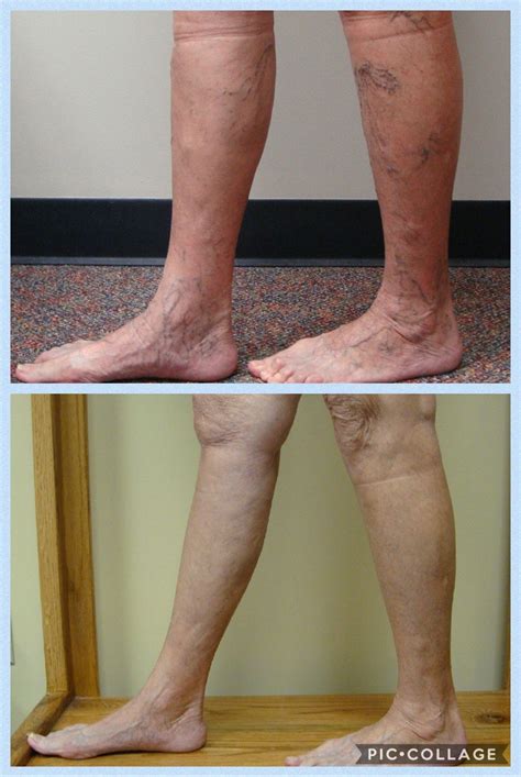 how to avoid spider veins 2