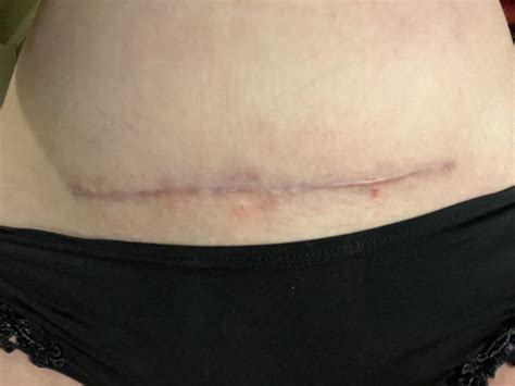Emergency c section scar after four months - still numb but healing