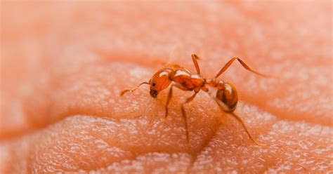 Alergia A Picadas De Formigas