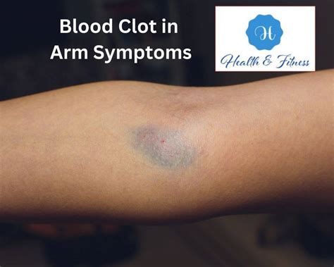 Blood Clot In Arm Symptoms: What You Need To Know Now